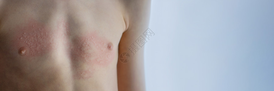 皮肤红斑皮肤上的荨麻疹 儿童皮肤过敏反应的红点 荨麻疹症状特写医生病人治疗斑点麻疹过敏水泡红斑症状孩子背景