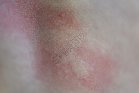 皮肤红斑皮肤上的荨麻疹 儿童皮肤过敏反应的红点 荨麻疹症状特写水泡孩子药品麻疹红色感染表皮皮炎皮疹治疗背景