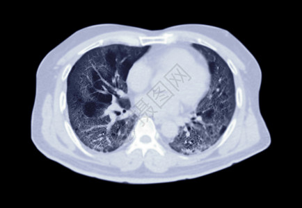 肺部图片CT扫描胸腔或肺轴对肺部感染的直观观察 共诊19次 地面玻璃不透明在黑色背景中隔离 切片路径背景