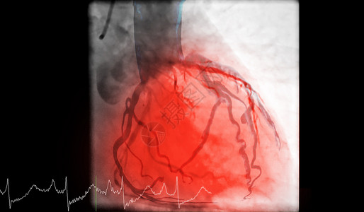 心脏导管化是一种测试 用来检测心跳停止扫描疾病外科核磁共振医院干涉诊断成人心导管术胸部图片