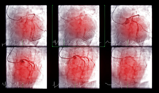 心脏导管化是一种测试 用来检测心跳停止心导管术疾病心血管胸部扫描疼痛心脏病学情况攻击诊断背景图片