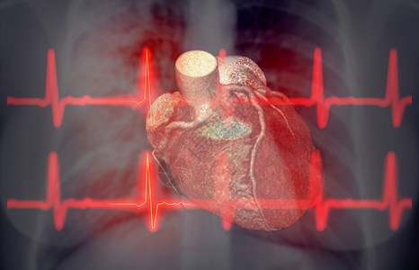 冠状动脉粥样硬化性心脏病使用 EKG 3D 立体成像的CHEST X光片 用于诊断船只冠状动脉衰竭心律失常扫描动脉瘤解剖学插图病人心脏病学器官医生断层背景