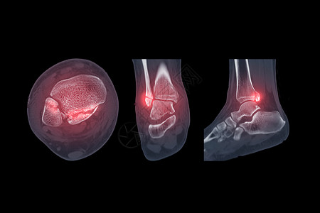 固定骨折脚踝关节CT扫描显示脚踝关节骨折背景