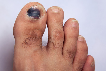 右脚脚指甲的伤痕背景图片