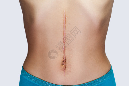 术后疤痕在腹部外科手术后 有大伤疤的年轻女性被关上背景