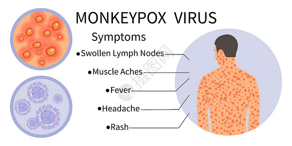 提高症状意识的猴子病毒横幅高清图片
