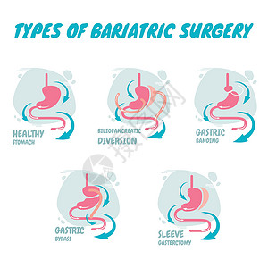 减肥手术的类型 它是胃消化系统的过程 一种新型的减肥手术背景图片