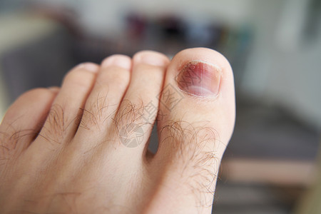 一个脚趾受伤 一个重物体掉在指甲下的血肿 伤痕损伤伤口痛苦事故出血身体皮肤病变创伤真菌背景图片