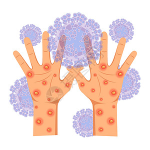 天花受皮疹 净化溃疡影响的人的手设计图片