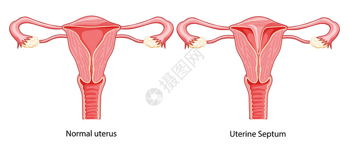 输卵管一组子子宫间隔膜 以正常和有病的子宫为主 女性生殖系统图插画