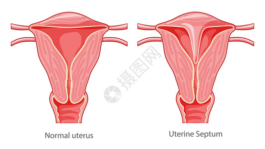 闭经一组子宫隔膜子宫女性生殖系统图正常并伴有疾病疼痛 切割前视图插画