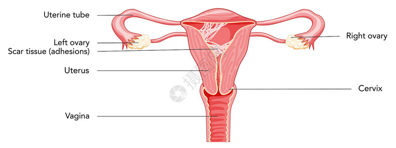 子宫图中的女性生殖系统疤痕组织粘合 上面有刻有字的表象 前视排卵生殖器器官女士妇科癌症身体卵巢药品图表背景图片