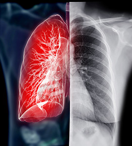 胸腔X射线和肺3D投影高清图片