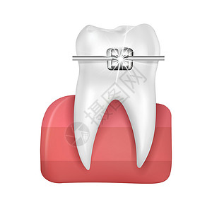 固定器逼真的 3D 矢量正畸治疗风格时尚美丽的蓝色 带金属托槽的洁白牙齿 在白色背景隔绝的牙套插画