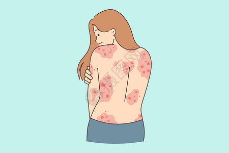 发痒的不健康的女人背着红疹子插画