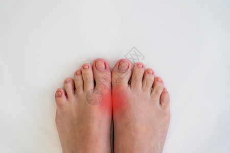 脚趾变形风湿病和痛风病 大脚趾与红点接头的疼痛性口味炎症女性痛风女士手指疾病风湿痛苦药品疼痛医疗背景