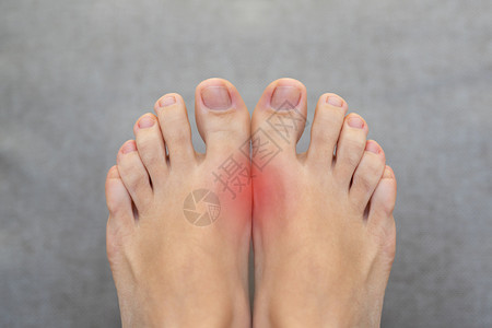 六脚趾脚病风湿病和口痛药 大脚趾与红点接头的疼痛性口味炎症风湿疼痛扭伤药品女性女士骨科痛苦伤害手指背景