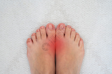 脚趾变形风湿病和痛风病 大脚趾与红点接头的疼痛性口味炎症疾病痛苦手指药品病人医疗骨科女士女性痛风背景