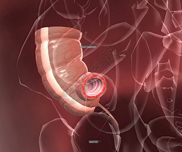 阑尾炎是指阑尾的炎症 指状囊从腹部右下侧的结肠突出情况痛苦癌症疼痛身体经期治疗压力医院厌食症背景