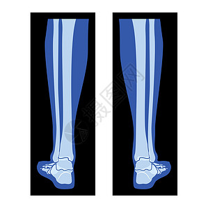 x型腿X光脚脚尖 Fibula 人体 骨骼成年人的伦琴背视插画