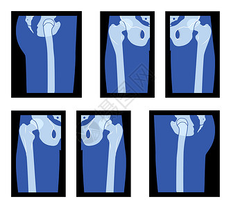 一组X光Hip和Leg 股骨头 Skeleton人体骨骼成人骨质动物 背面视线是伦琴插画
