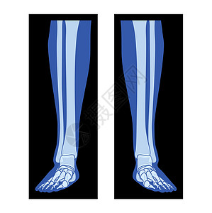 x型腿X Ray 脚脚腿尖尖 Fibula 人体 Bones成年人的伦琴前视3D现实公寓插画