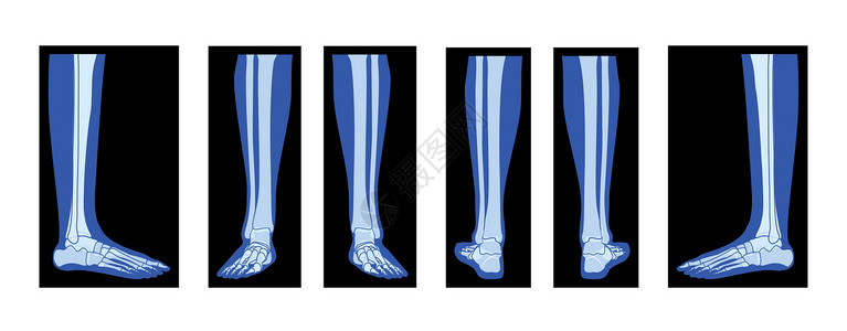 x型腿一组X光脚脚腿斯凯勒顿人的身体 骨骼成年人的伦琴前侧视角插画