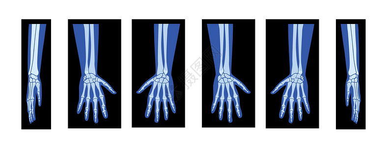 人体学一组X光手与半径 人体 骨骼成年人的伦琴前侧视角插画