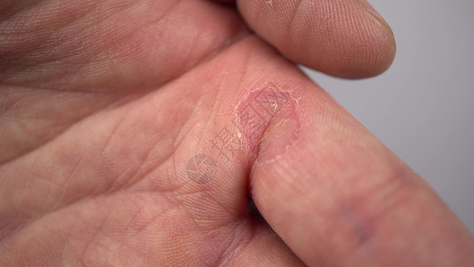 皮肤溃疡对一个人的手指起火 将大对皮肤起火背景