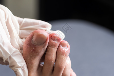 丘疹性荨麻疹男人的脚趾显示什么看起来像红发皮肤皮疹 Covid19通常被称为Covid脚趾的一个常见副作用治疗痛苦疾病冻疮病变皮肤科水泡荨麻背景