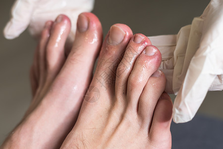 男人的脚趾显示什么看起来像红发皮肤皮疹 Covid19通常被称为Covid脚趾的一个常见副作用症状痛苦斑点皮肤科荨麻疹指甲肺炎身背景图片