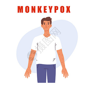 肌肉男人猴痘病毒 有皮疹的人 皮肤感染 猴痘病毒信息图 孤立的矢量图设计图片