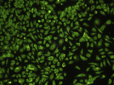 非小细胞肺癌人类肺癌细胞药店医院显微镜实验绿色生物学药品实验室疾病危险背景