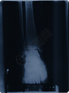 x射线医院身体骨头生物学踝关节解剖学科学骨骼x光手指背景图片