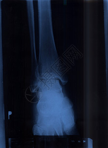 x射线x光生物学身体骨头骨骼科学踝关节医院解剖学手指背景图片