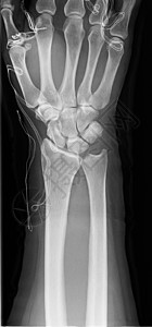 X射线手软骨痛风关节炎腕关节射线手指手腕背景