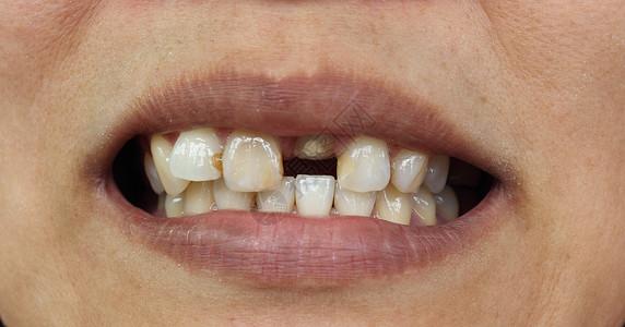 变色的牙齿牙牙缝合坏牙齿背景
