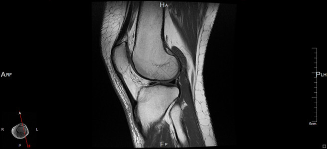 磁共振成像软骨关节身体神经左膝器官白色肌肉辐射黑色背景图片