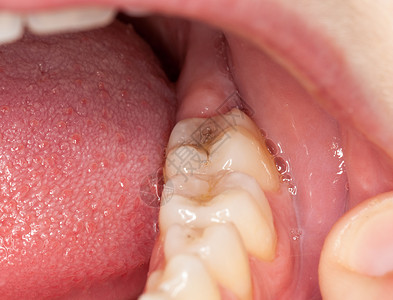 变色的牙齿填满牙齿的宏图像鞑靼宏观牌匾牙科保健金属变色病理皇冠临床背景