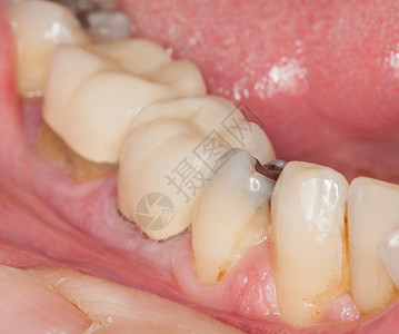 变色的牙齿牙科打开高清图片
