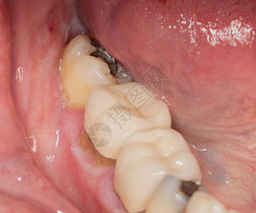 变色的牙齿填满牙齿的宏图像磨牙唾液金子病理临床空腔合金皇冠衰变舌头背景