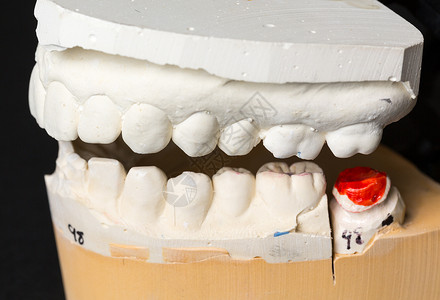 整蛊盒子用于整牙术的假牙科学塑料铸件假肢微笑牌匾矫正正畸学衰变药品背景