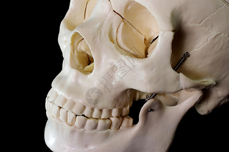 牙齿窝沟下颌整骨疗法高清图片