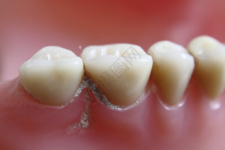 牙齿问题病人牙科门牙牙疼治疗卫生鞑靼学习清洁水泥高清图片