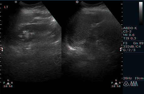 人体内脏超声检查器官身体考试辐射胆囊扫描保健疾病测试膀胱背景图片