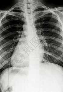 胸片胸前X光扫描疾病射线电影肋骨放射科骨骼人类医疗考试x射线背景