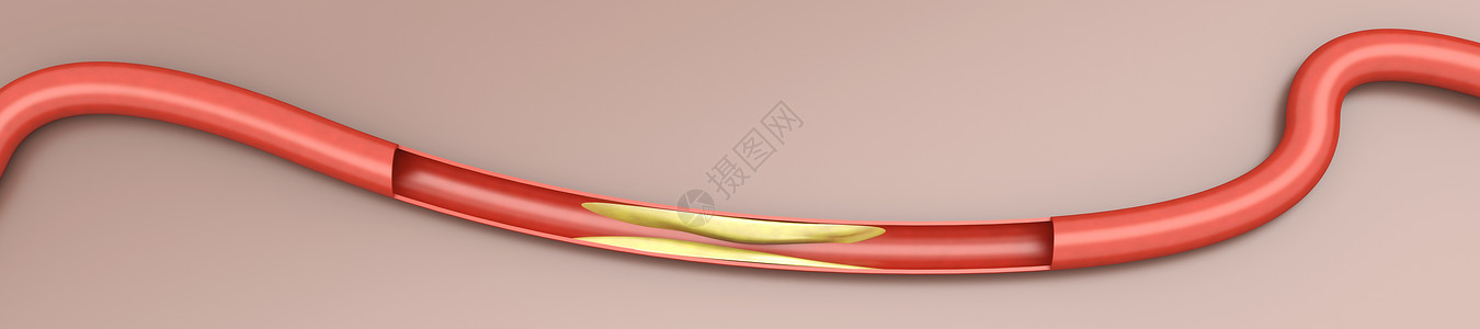 动脉硬化预防插图药品生活心脏病学解剖学宏观血栓血管健康背景图片