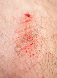 膝盖上的划痕伤口头发疼痛皮肤背景图片