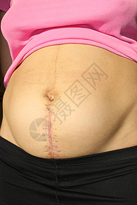 术后疤痕剖腹产手术后接缝药品绳索婴儿腹部生育生殖皮肤送货母亲母性背景