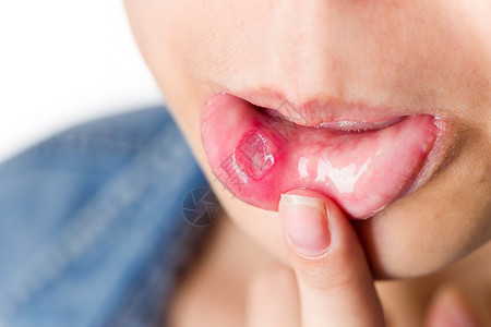 舌头溃疡素材怀有严重艾发的妇女背景